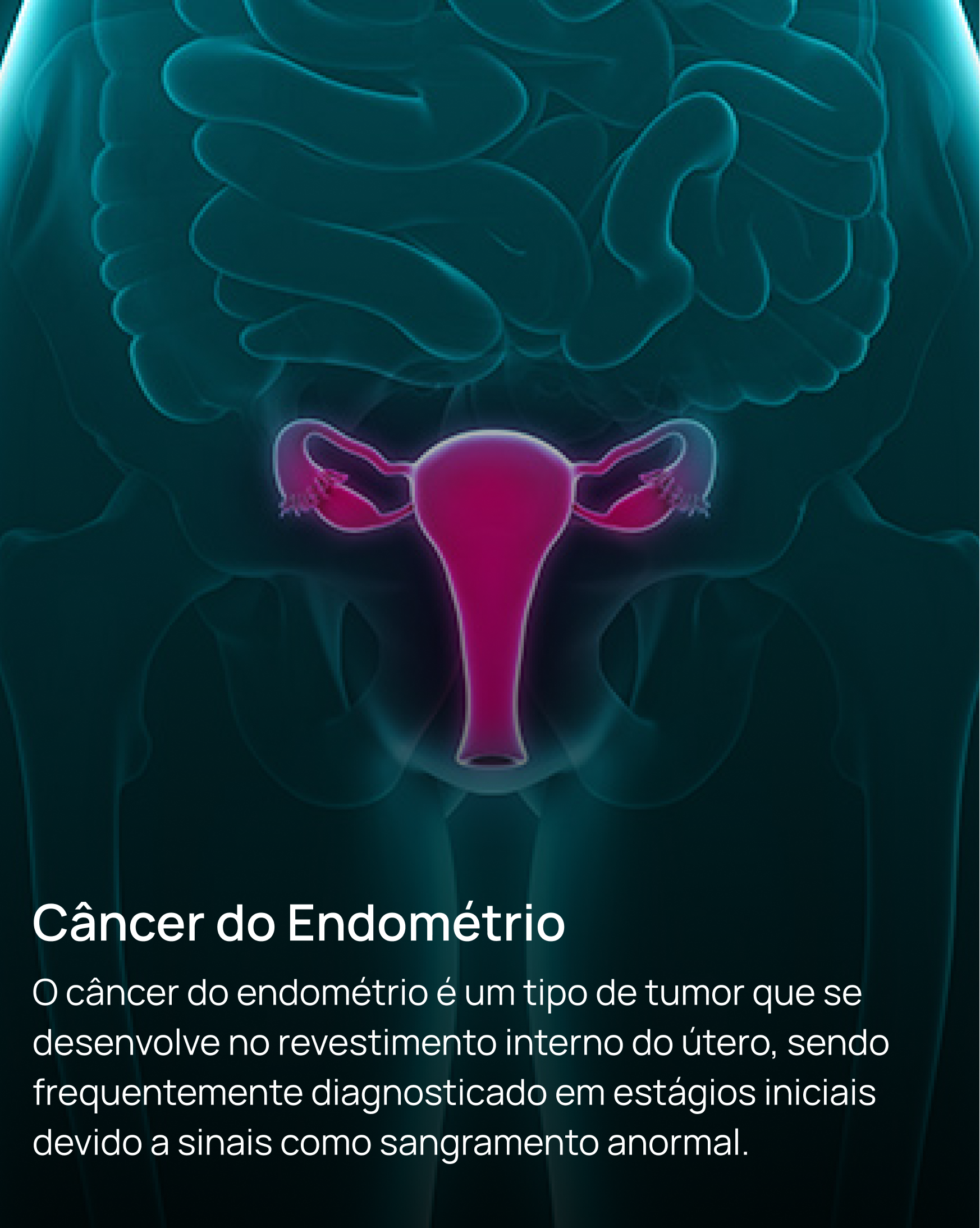 Câncer do Endométrio