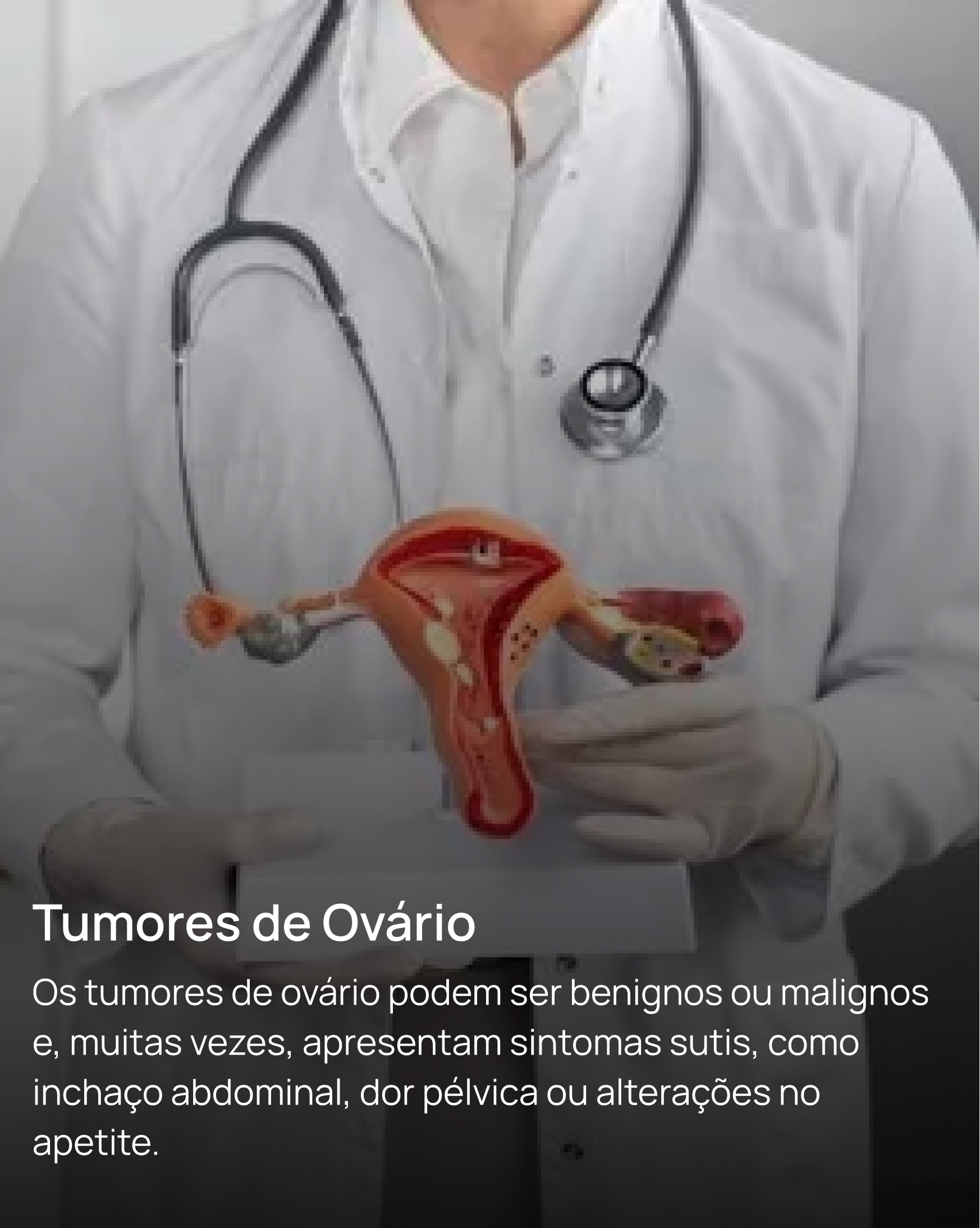 Tumores de Ovário 2x